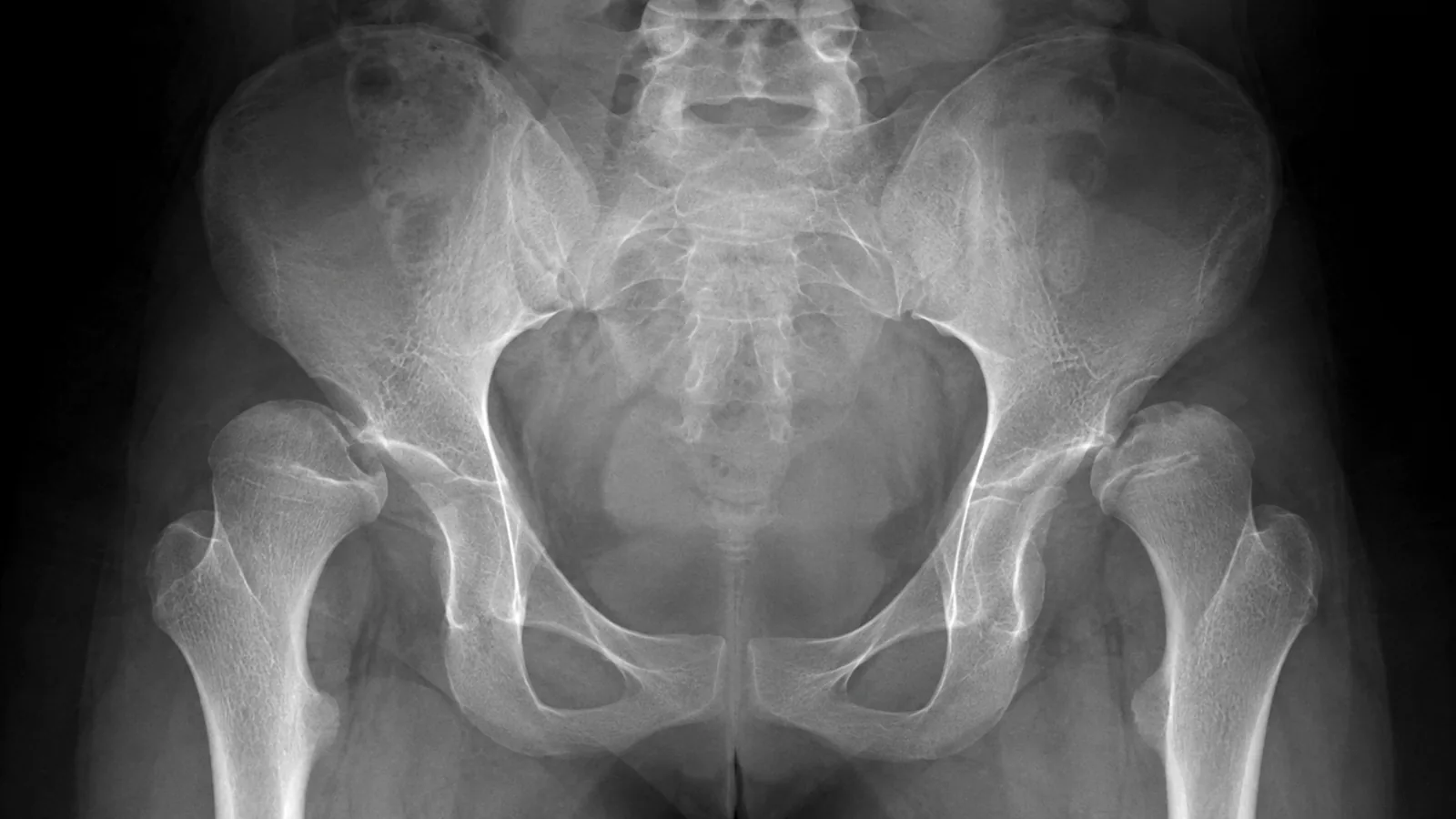 La dysplasie de la hanche chez le chien : signes et soins